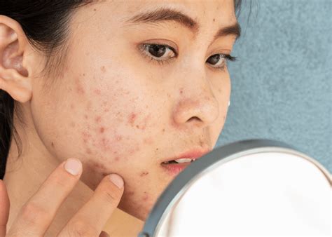 5 Langkah Jitu Perawatan Wajah Berjerawat and Berminyak: Bye-bye Kilang Minyak! 5 Langkah Jitu Perawatan Wajah Berjerawat and Berminyak: Bye-bye Kilang Minyak!