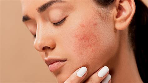 5 Rahasia Ampuh Mengatasi Kulit Kering: Wajah Lembap Seketika!