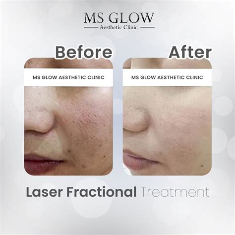 5 Rahasia Harga Laser Wajah MS Glow: Jangan Kaget, Ini Bocorannya!