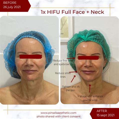 7 Cara Efektif untuk Maksimalkan Perawatan Hifu agar Hasilnya Lebih Awet dan Mempesona! 7 Cara Efektif untuk Maksimalkan Perawatan Hifu agar Hasilnya Lebih Awet dan Mempesona!