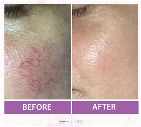 7 Cara Laser Perawatan Wajah yang Bisa Ubah Penampilanmu dalam Semalam! 7 Cara Laser Perawatan Wajah yang Bisa Ubah Penampilanmu dalam Semalam!