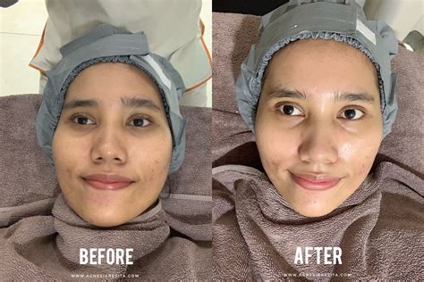 Berapa Biaya Facial di Erha? Siapkan Budget Segini! (Update 2024)