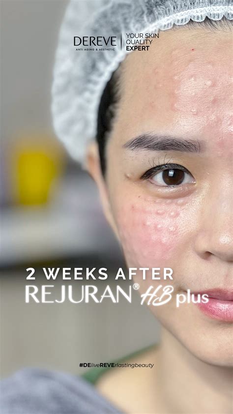 5 Rahasia Kulit Glowing Setelah Treatment Dermapen yang Wajib Kamu Tahu! 5 Rahasia Kulit Glowing Setelah Treatment Dermapen yang Wajib Kamu Tahu!