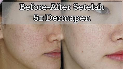 5 Rahasia Kulit Glowing Setelah Treatment Dermapen yang Wajib Kamu Tahu! 5 Rahasia Kulit Glowing Setelah Treatment Dermapen yang Wajib Kamu Tahu!