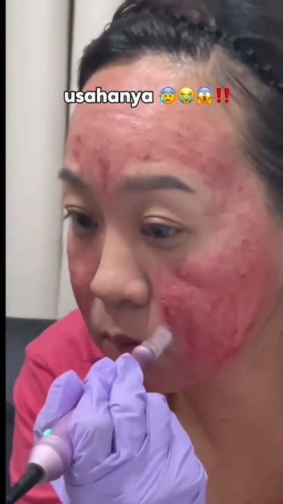 5 Rahasia Kulit Glowing Setelah Treatment Dermapen yang Wajib Kamu Tahu! 5 Rahasia Kulit Glowing Setelah Treatment Dermapen yang Wajib Kamu Tahu!