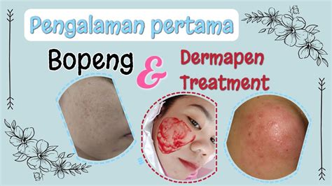 5 Rahasia Kulit Glowing Setelah Treatment Dermapen yang Wajib Kamu Tahu! 5 Rahasia Kulit Glowing Setelah Treatment Dermapen yang Wajib Kamu Tahu!