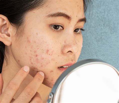 5 Rahasia Skincare Athena Untuk Jerawat Vanish! 5 Rahasia Skincare Athena Untuk Jerawat Vanish!