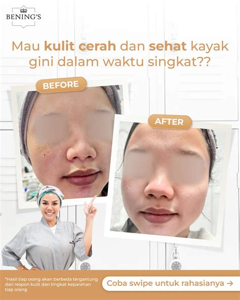 7 Promo Bening's Clinic yang Bikin Kulit Glowing, Dompet Tetap Tebal! 7 Promo Bening's Clinic yang Bikin Kulit Glowing, Dompet Tetap Tebal!