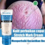 7 Treatment Ampuh Menghilangkan Stretch Mark dalam 30 Hari, Hasilnya Maksimal!