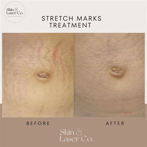 7 Treatment Ampuh Menghilangkan Stretch Mark dalam 30 Hari, Hasilnya Maksimal! 7 Treatment Ampuh Menghilangkan Stretch Mark dalam 30 Hari, Hasilnya Maksimal!