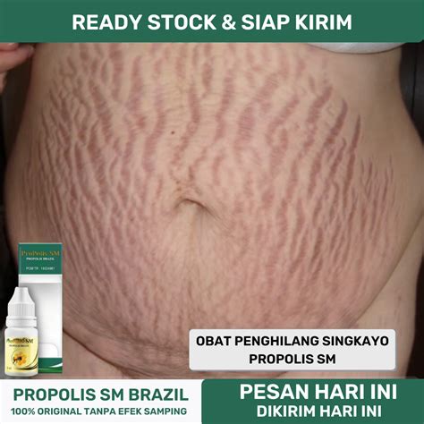 7 Treatment Ampuh Menghilangkan Stretch Mark dalam 30 Hari, Hasilnya Maksimal! 7 Treatment Ampuh Menghilangkan Stretch Mark dalam 30 Hari, Hasilnya Maksimal!
